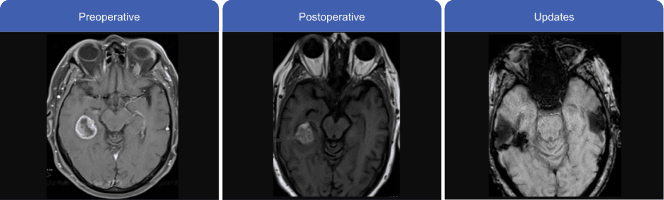 Horizontal MRI scan comparison, showing progression from preoperative to postoperative and updated scans.