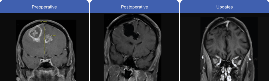 Horizontal MRI scan comparison, showing progression from preoperative to postoperative and updated scans.