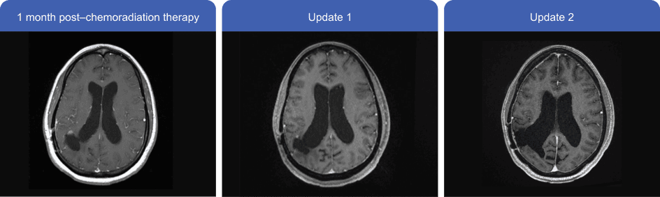 Horizontal MRI scan comparison, showing progression from preoperative to postoperative and updated scans.