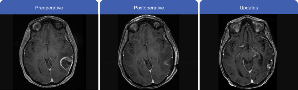 Horizontal MRI scan comparison, showing progression from preoperative to postoperative and updated scans.